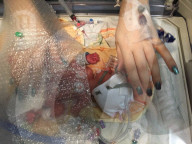 SCHICKSALE - Frühgeborenes Baby überlebt dank Plastiksack