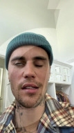 PEOPLE - Bei Justin Bieber ist das Ramsay-Hunt-Syndrom diagnostiziert worden