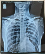 FEATURE - Beim Trinken von heiligem Wasser: Ärzte operieren erfolgreich verschluckte Metallfigur des Hindu-Gottes Krishna aus dem Rachen von Vinayak Kolkekar