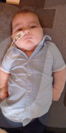 SCHICKSALE - Erster Geburtstag, erster Schlaganfall: Baby Blake Hanchett aus Pocklington wird wohl nie normal reden und laufen können