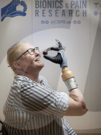 First successful long-term integration of a bionic hand.                        