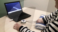 First successful long-term integration of a bionic hand.                        