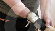 First successful long-term integration of a bionic hand.                        