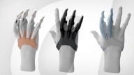 Free to 3D print prosthesis for finger amputees