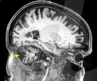 Treatment with magnets improves stroke victim's balance  and coordination