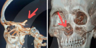 Man suffering headaches had chopsticks up nose for five months