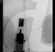 Tiny screw-shaped robots designed to clear blood clots