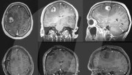 Wide awake guitarist strums his way through brain surgery