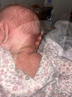 FEATURE - Georgia House, deren Baby Margot mit Masern ins Krankenhaus eingeliefert wurde, bittet die Menschen sich impfen zu lassen