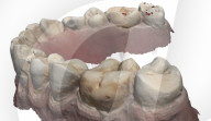 Robot dentist successfully completes first procedure on a patient