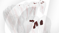 Robot dentist successfully completes first procedure on a patient