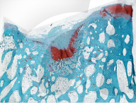 New biomaterial regrows damaged cartilage in joints