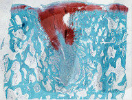New biomaterial regrows damaged cartilage in joints