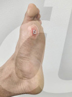 Inexpensive dressing heals chronic wounds up to 30 percent faster