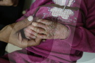 Palestinian girl diagnosed with rare skin disease