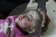 Palestinian girl diagnosed with rare skin disease