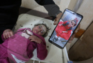 Palestinian girl diagnosed with rare skin disease