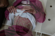 Palestinian girl diagnosed with rare skin disease