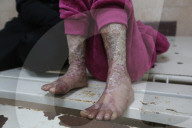 Palestinian girl diagnosed with rare skin disease