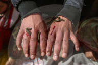 Leech Therapy On Nowruz Day In Kashmir