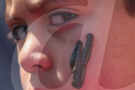 Leech Therapy On Nowruz Day In Kashmir