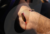 Leech Therapy On Nowruz Day In Kashmir