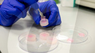 Help for diabetic wounds with dissolveable micro-needles that clean and deliver drugs