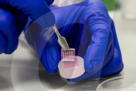 Help for diabetic wounds with dissolveable micro-needles that clean and deliver drugs