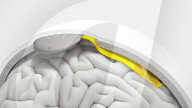Minimally invasive brain implant gets regulatory clearance