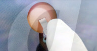 Minimally invasive brain implant gets regulatory clearance