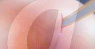 Minimally invasive brain implant gets regulatory clearance