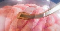 Minimally invasive brain implant gets regulatory clearance
