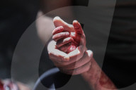 Gaza wounded and dead in hospital