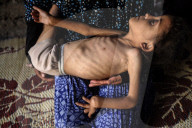 Malnutrition Emergency In Gaza