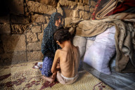Malnutrition Emergency In Gaza
