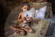 Malnutrition Emergency In Gaza