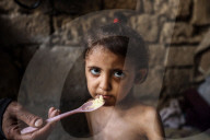 Malnutrition Emergency In Gaza