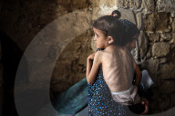 Malnutrition Emergency In Gaza