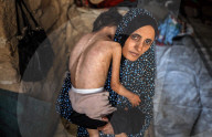 Malnutrition Emergency In Gaza