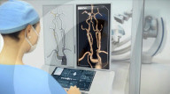 Robot for removing blood clots in stroke victims