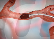 Robot for removing blood clots in stroke victims