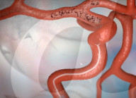 Robot for removing blood clots in stroke victims