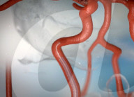 Robot for removing blood clots in stroke victims