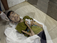 Gaza man dies of severe malnutrition