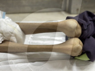 Gaza man dies of severe malnutrition