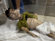 Gaza man dies of severe malnutrition