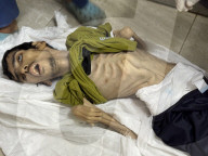 Gaza man dies of severe malnutrition