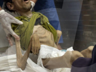 Gaza man dies of severe malnutrition