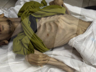 Gaza man dies of severe malnutrition