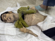 Gaza man dies of severe malnutrition